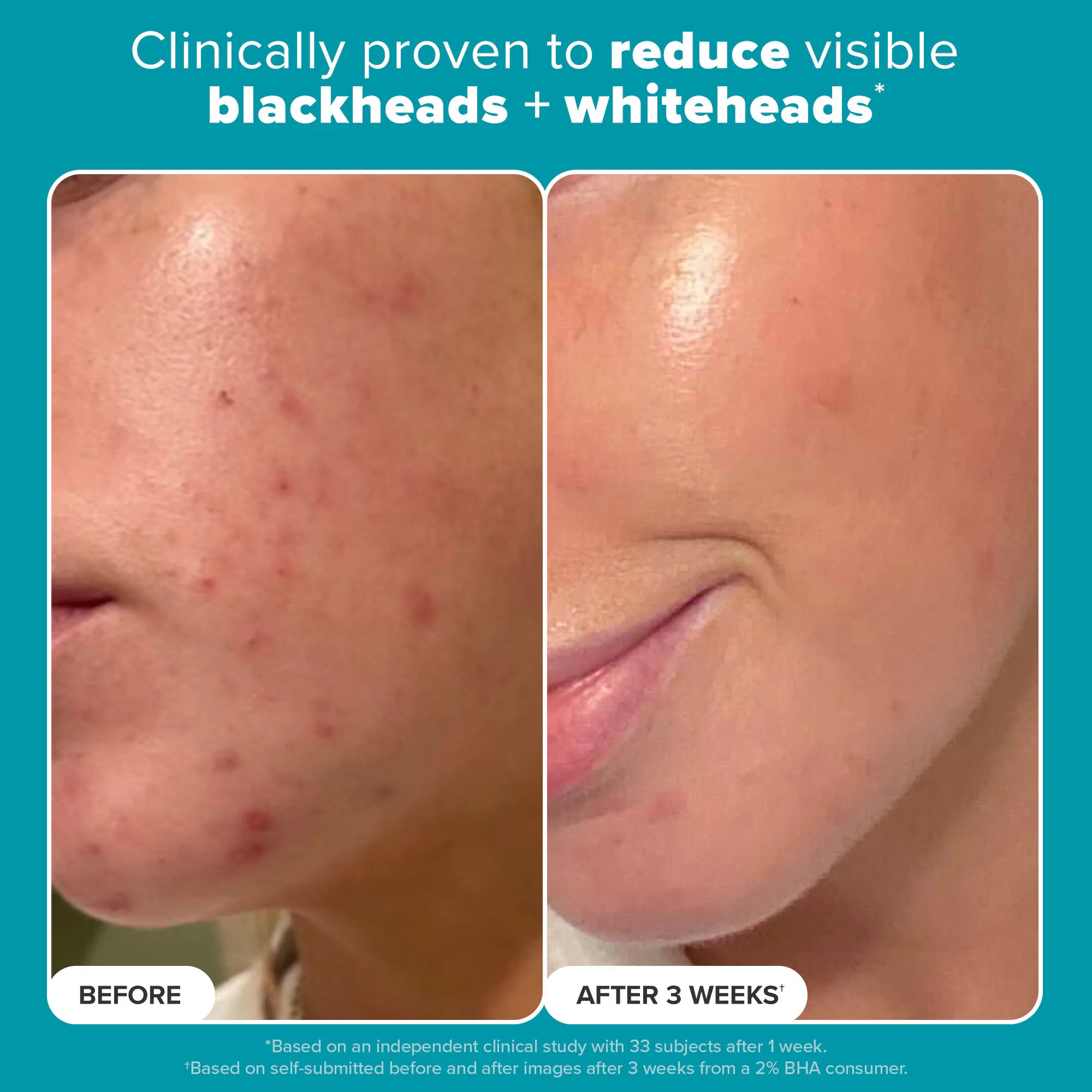 Tónico exfoliante Skin Perfecting con 2 % de BHA para una piel limpia