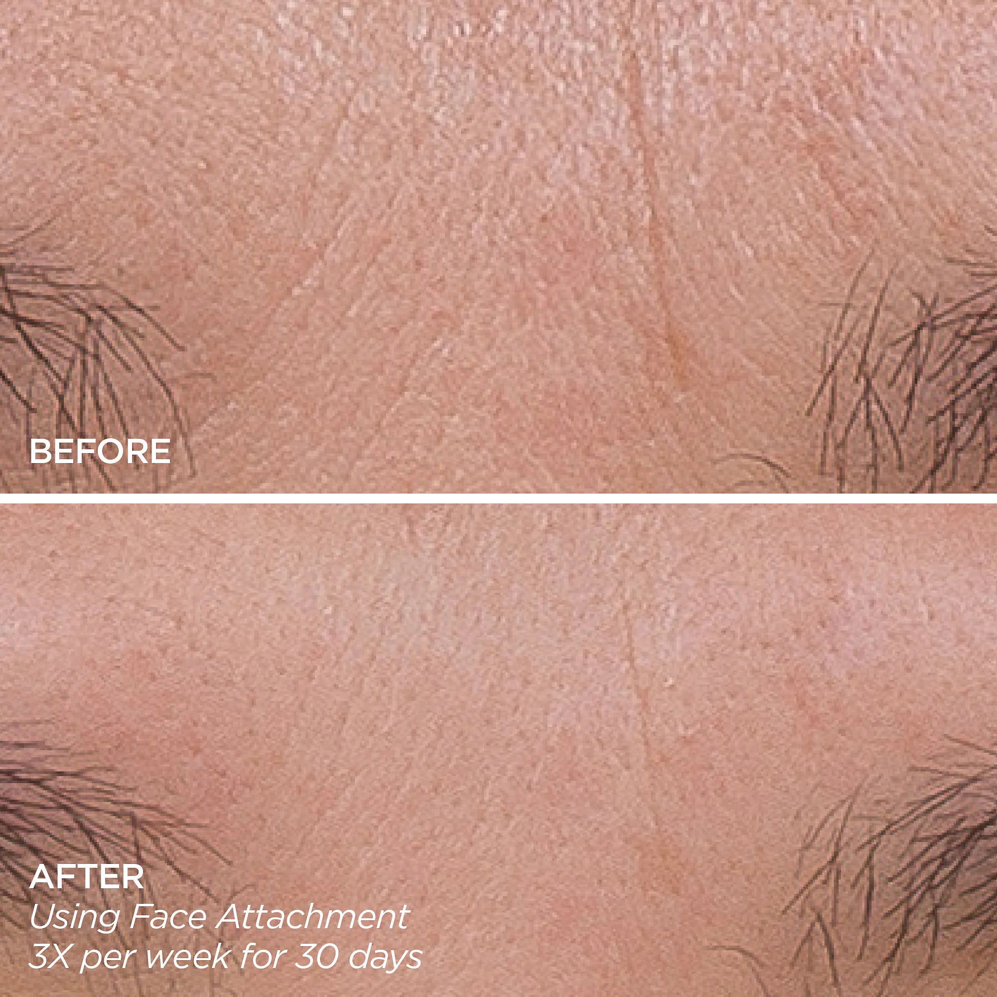 Consigue ese brillo - Kit de herramientas de microagujas y descubrimiento GloPRO®