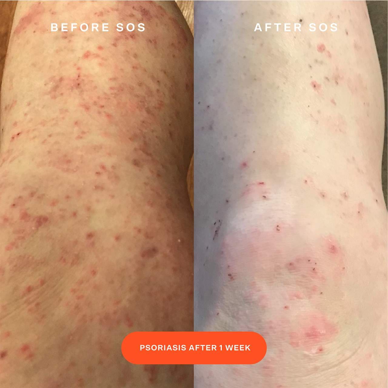 Spray facial SOS Daily Rescue con ácido hipocloroso